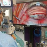 El Hospital de Riotinto perfecciona la cirugía de glaucoma con un procedimiento mínimamente invasivo